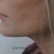 Lifting du visage