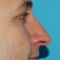 Plastika nosu (Rhinoplastika)