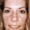 Procedure laser in dermatologia estetica