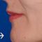 Nasenkorrektur - Rhinoplastik