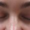 Neinvazivní blefaroplastika
