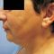 Facelift (operace obličeje), SMAS lifting