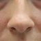 Kwas hialuronowy: Saypha, Restylane, Juvederm, Stylage
