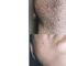 Depilazione laser