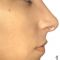 Plastika nosu (Rhinoplastika)