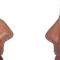 Operácia nosa (Rhinoplastika)