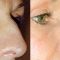 Rhinoplastie