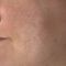 Laser Scar Treatment