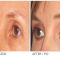 Eyelid surgery (Blepharoplasty)