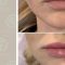 Teosyal, Restylane, Esthelis, Juverdem, Surgiderm (preparáty kyseliny hyaluronovej)