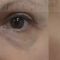 Operácia očných viečok (Blepharoplastika)