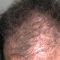 Trapianto capelli