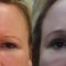 Operace čela (Forehead lift)