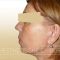 Facelift, SMAS Facelift