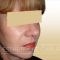 Facelift, SMAS Facelift