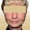 Facelift, SMAS Facelift