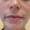 Lip augmentation - cheiloplasty