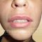 Lip augmentation - cheiloplasty