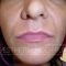 Lip augmentation - cheiloplasty
