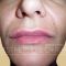 Lippenvergrößerung