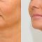 Feather face-lift APTOS
