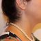 Exilis (Nicht-invasives Lifting)