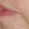 Fotorejuvenace / Resurfacing