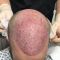 Haartransplantation
