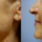 Facelift (operace obličeje), SMAS lifting