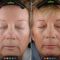 Rádiofrekvenčná rejuvenácia(Aluma, accent, TriPollar, Spa RF, Re-Age)