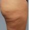 Alternativa alla liposuzione - rimozione del grasso e della cellulite non invasiva