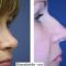 Operácia nosa (Rhinoplastika)
