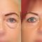 Eye Bags Treatment