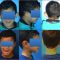 Otoplastie (Chirurgie esthétique des oreilles)