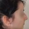 Rhinoplastie