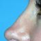 Plastika nosu (Rhinoplastika)