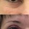 Operace očních víček (Blefaroplastika)