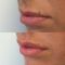 Injections d
