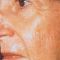Laserové zákroky estetické dermatologie