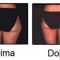 Alternativa alla liposuzione - rimozione del grasso e della cellulite non invasiva