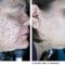 Laserowe zabiegi dermatologii estetycznej
