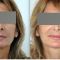 Mini lifting (lifting cervico-facial)