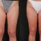 Chirurgie des cuisses