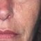 Facelift, SMAS facelifting