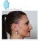Rhinoplastie