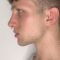 Operácia nosa (Rhinoplastika)