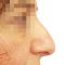 Operácia nosa (Rhinoplastika)