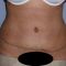 Abdominoplastika (Operace břicha)