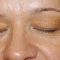 Laser skin tag removal
