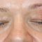 Laser skin tag removal